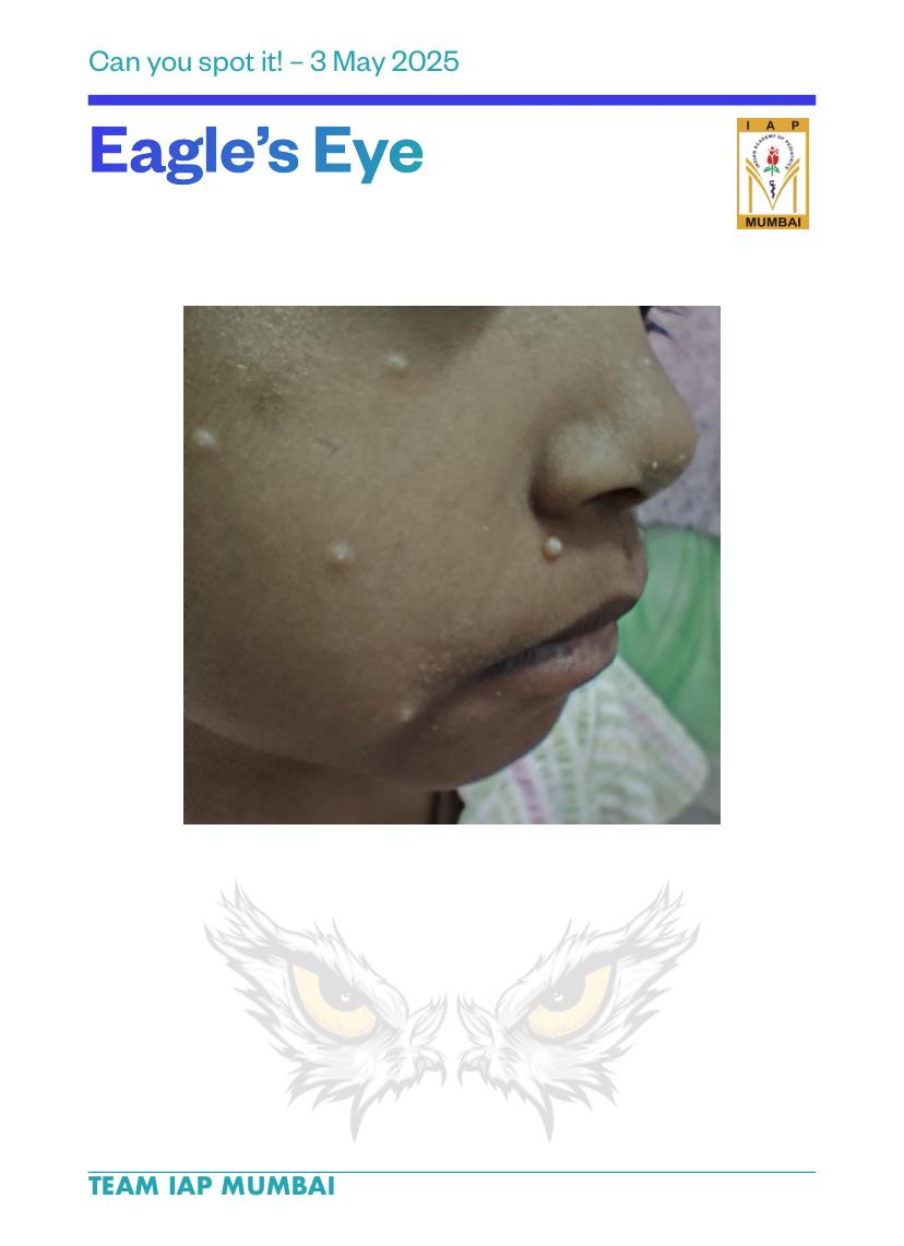 Molluscum Contagiosum