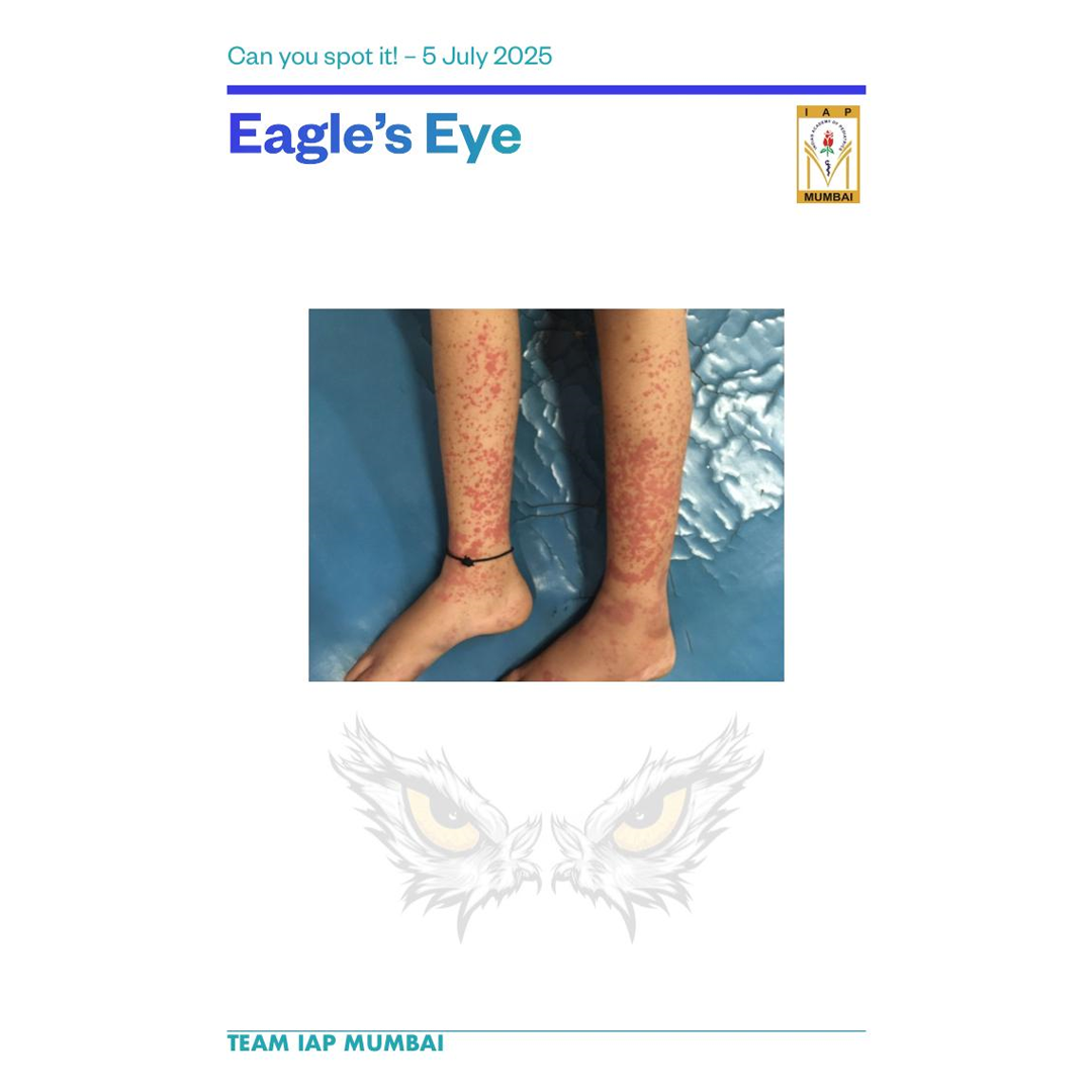 Henoch-Schönlein purpura (HSP) rash